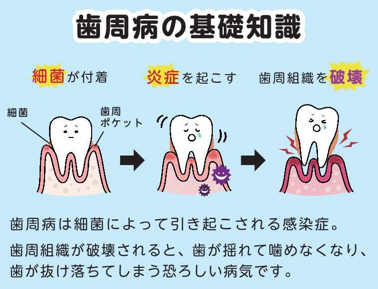 歯周病発生のメカニズム 歯周病発生のメカニズム